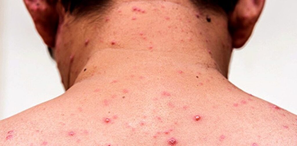 Regresa una enfermedad prácticamente erradicada en la región.