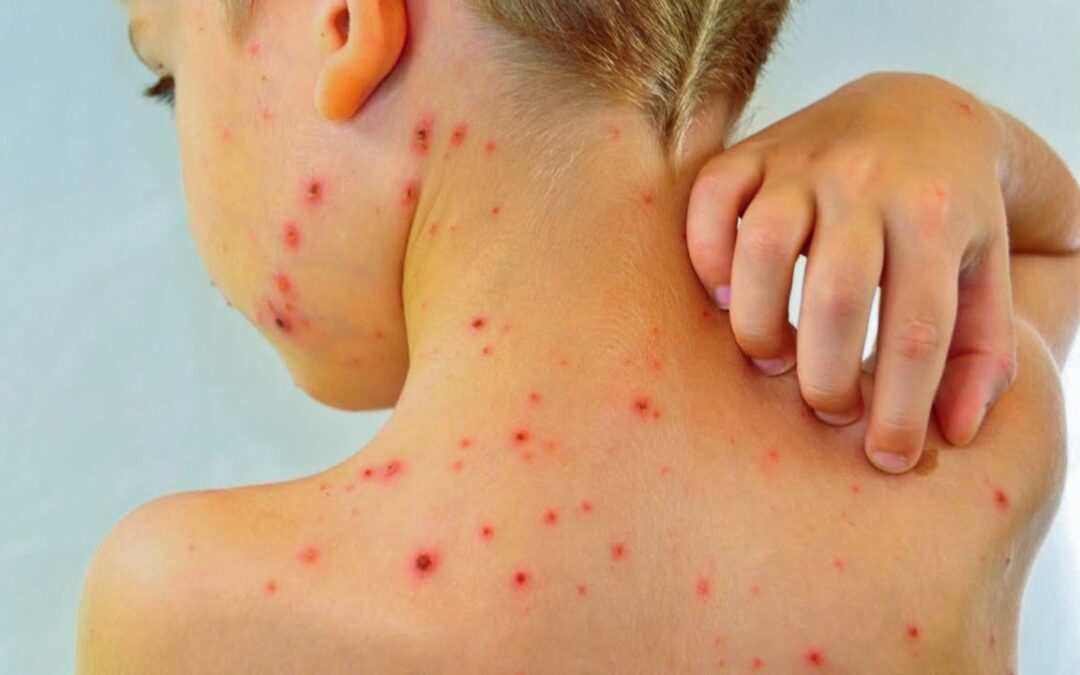 Regresa una enfermedad prácticamente erradicada en la región.